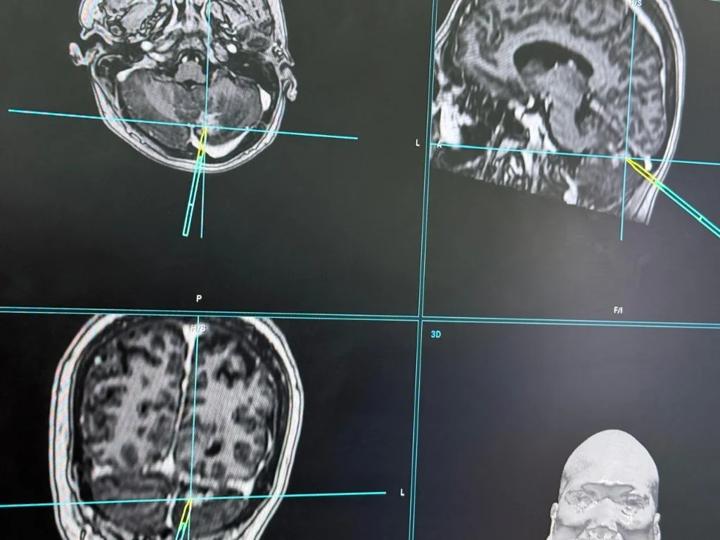 Neuronavigation System