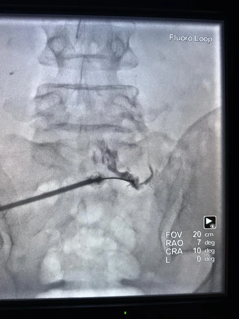 Fluoroscopy Sciatica Procedure 1