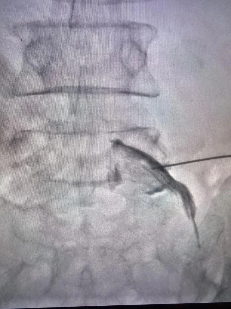 Fluoroscopy Sciatica Procedure 2
